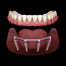 All-on-4 dental implant prosthesis showing tooth crown restoration and implant fixture placement in jawbone.