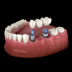 Dental implants model showing two titanium posts in jaw bone with artificial teeth restoration.