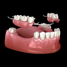 3D dental implant model showing tooth replacement options on pink gum base against black background.