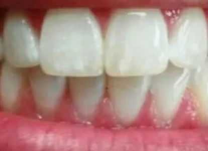 Close-up of healthy white teeth and pink gums showing dental health and proper oral care results.