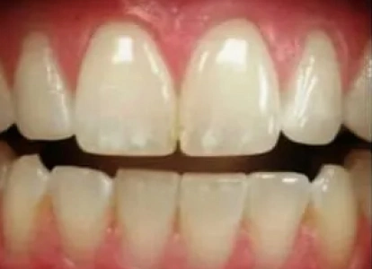 Close-up of white dental veneers on upper front teeth showing cosmetic dental results.