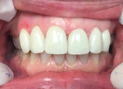 Close-up view of healthy white teeth and pink gums in open mouth dental examination.
