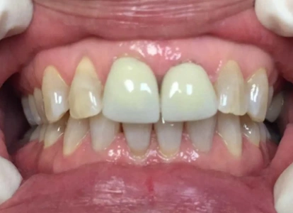 Close-up of upper and lower teeth showing dental work and tooth color variations in clinical setting.