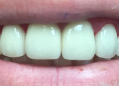 Close-up of four upper front teeth showing white dental crowns or restorations in a mouth.