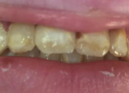 Close-up view of upper front teeth showing discoloration and decay requiring dental treatment.