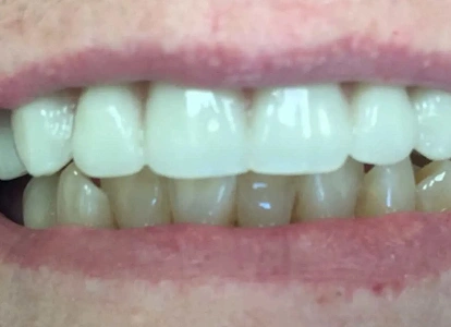 Close-up of teeth showing upper and lower dental work, displaying cosmetic dental results and tooth alignment.