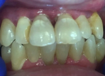 Close-up intraoral view of upper front teeth showing discoloration and wear requiring dental restoration.