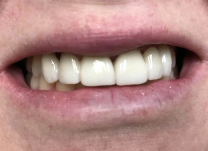 Close-up of person's smile showing white teeth and pink lips against skin.