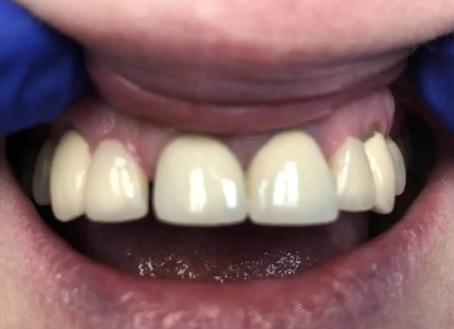 Close-up of upper front teeth showing dental crowns or veneers in a smile.
