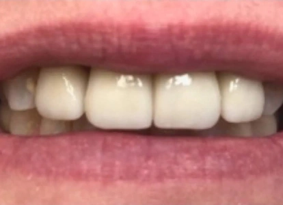 Close-up of upper front teeth showing natural smile with healthy white teeth and pink gums.