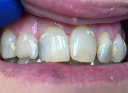 Close-up of upper front teeth showing discoloration and enamel irregularities in dental care context.