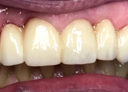 Close-up of upper front teeth showing dental work with natural-looking crowns and restorations.