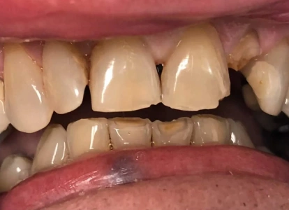 Close-up intraoral view showing upper and lower teeth with visible dental work and natural tooth structure.