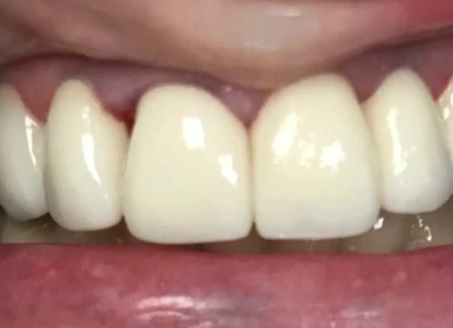 Close-up of five white dental veneers or crowns on upper front teeth showing cosmetic dental work.