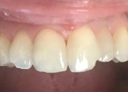 Close-up view of four natural-looking dental crowns or veneers on upper front teeth.