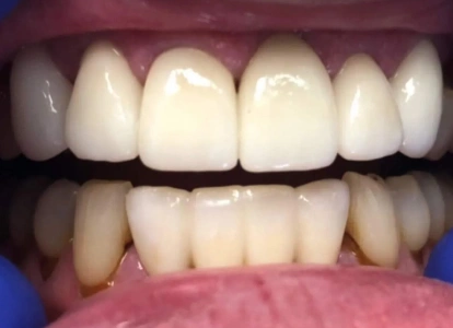 Close-up dental photograph showing upper and lower teeth with whitening results comparison, professional dental care setting.