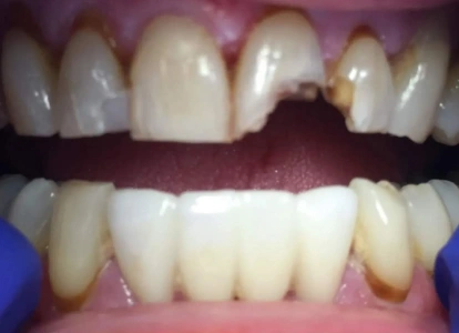 Dental before and after comparison showing upper and lower teeth restoration treatment results.