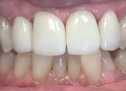 Close-up dental photograph showing upper front teeth with white crowns and visible gum line.