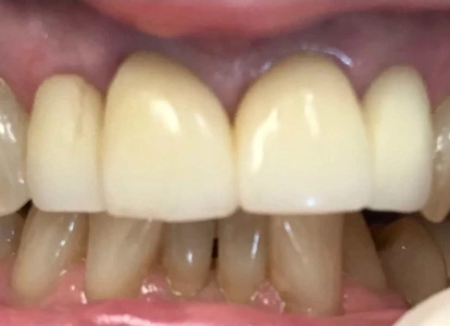 Close-up of upper front teeth showing natural tooth color and dental restoration results.