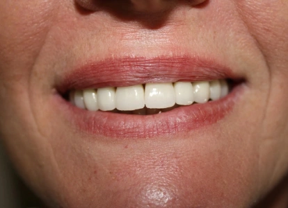 Close-up of person's smile showing white, healthy teeth and natural lips.