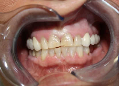 Close-up of patient's teeth showing dental alignment and oral health during examination.