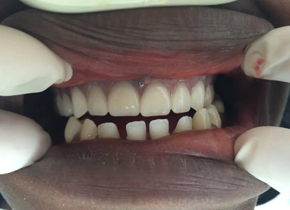 Dental professional examining patient's teeth and gums during oral examination in dental office.