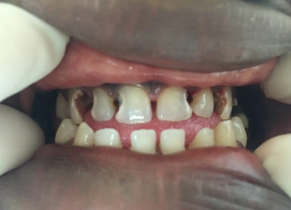 Close-up dental examination showing patient's teeth with visible gaps and discoloration before treatment.