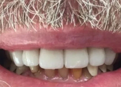 Close-up of bright white teeth and smile showing dental care results and oral health.