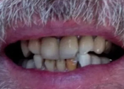 Close-up of teeth showing discoloration and misalignment before dental treatment.