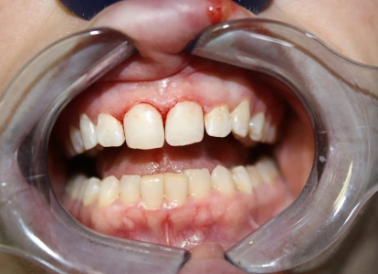 Dental examination showing open mouth with teeth visible using cheek retractors during oral assessment.
