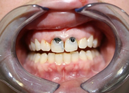 Dental examination showing front teeth with retractor, displaying tooth condition and oral health assessment.