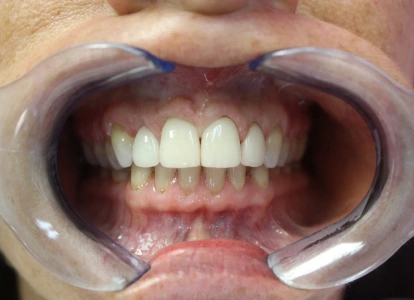 Dental retractor showing upper front teeth during oral examination at dental office