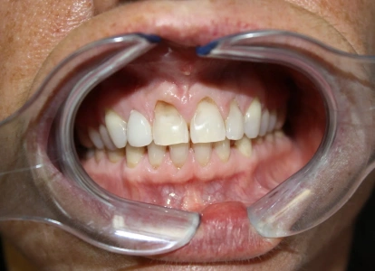 Dental examination showing open mouth with teeth and gums during professional dental care inspection.