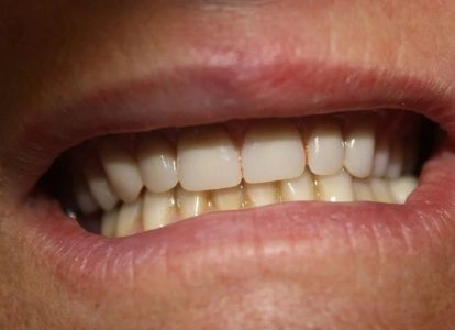 Close-up of smiling mouth displaying natural teeth and healthy gums in dental care context.
