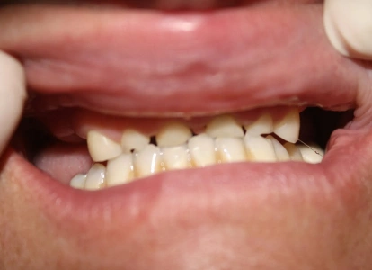 Close-up of open mouth showing teeth with visible gaps and misalignment requiring dental care.