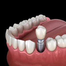Dental implant illustration showing titanium post and crown replacing missing tooth in jawbone model.