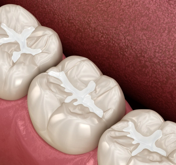 Close-up view of dental restorations on teeth showing white composite fillings against pink gum tissue.