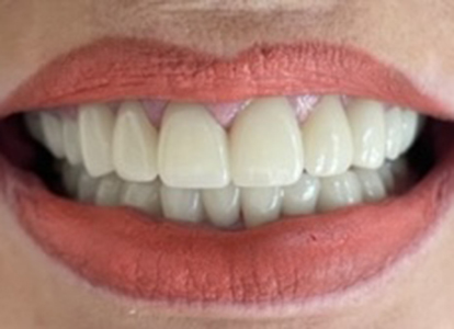 Close-up of healthy white teeth and pink lips displaying a bright smile.