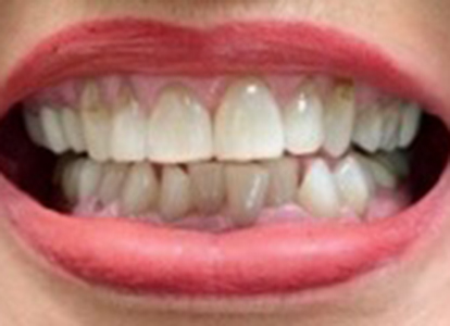 Close-up of open mouth showing upper and lower teeth with visible dental work and gum line.