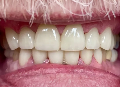 Close-up view of upper and lower teeth showing dental work and oral health examination.