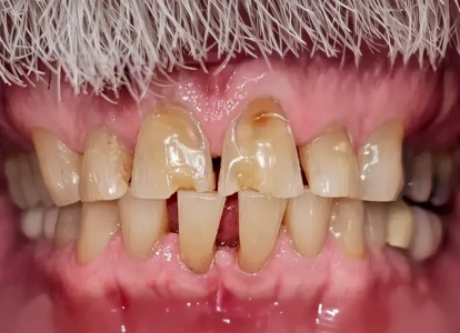 Close-up of dental condition showing discolored, misaligned teeth with visible gaps and gum inflammation.