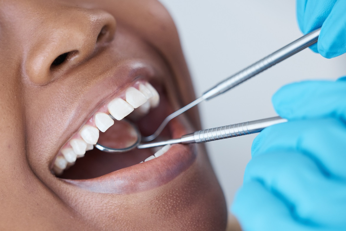 why early cavity treatment matters by dentist florence