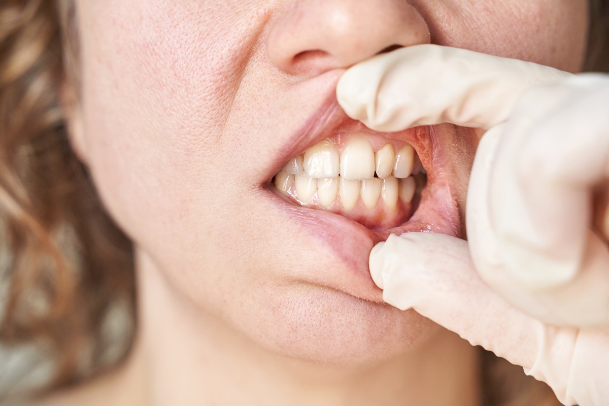 Why tartar builds up even with good hygiene